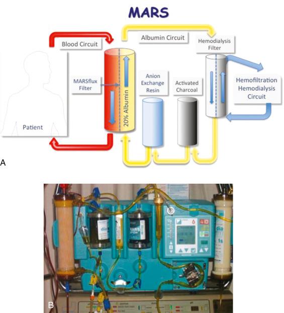 FIGURE 107-1, Schematic of the molecular adsorbent recirculating system (MARS) ( A ) and photograph ( B ).