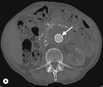 Fig. 77.1, Successful Treatment of an Aortic Aneurysm With a Fenestrated Endovascular Graft.