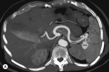 Fig. 77.2, Patient with incidental splenic artery aneurysm (SAA) demonstrated on computed tomography abdomen performed for lower abdominal pain. (A) Axial multiplanar reformat (MPR): note avidly enhancing 3-cm SAA at the splenic hilum (SplA) . (B) Coronal oblique MPR demonstrates the SAA. SMA , Superior mesenteric artery; SplA , splenic artery.