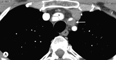 Fig. 77.3, Acute Aortic Dissection.