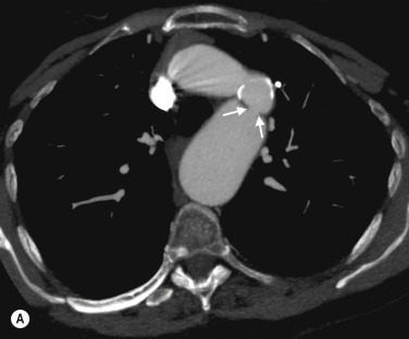 Fig. 77.4, Thoracic Aortic Coarctation in a Young Patient With Severe Upper Limb Hypertension.