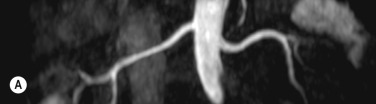 Fig. 77.6, Patient With Hypertension Undergoing Renal Magnetic Resonance Angiography (MRA) for Suspected Renal Artery Stenosis.
