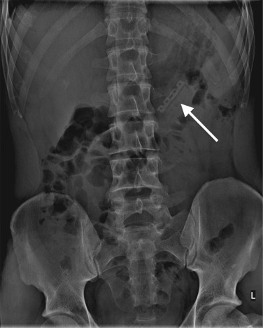 Fig. 18.1, Intra-abdominal Foreign Body.