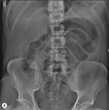 Fig. 18.11, Small-Bowel Obstruction.