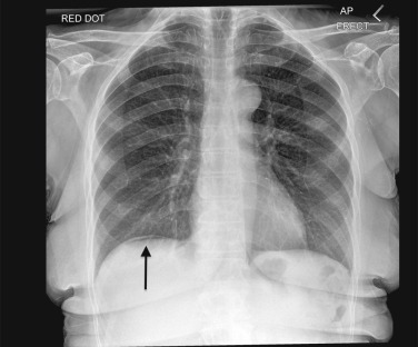 Fig. 18.2, Pneumoperitoneum.