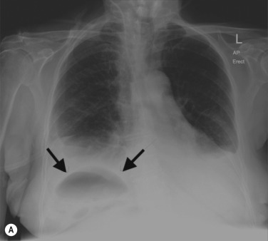 Fig. 18.3, Subphrenic Abscess Mimicking Pneumoperitoneum.