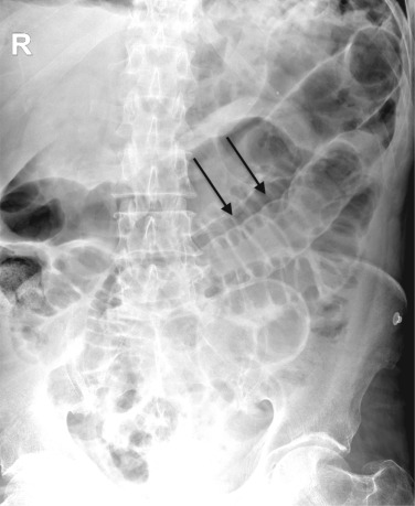 Fig. 18.4, Pneumoperitoneum in a Patient With Ulcerative Colitis.