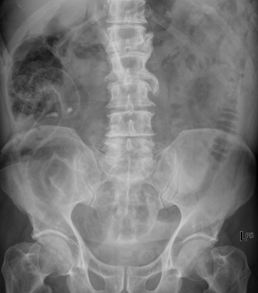 Fig. 18.5, Pneumoperitoneum.