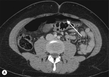 Fig. 18.6, Free Peritoneal Gas Due to Perforated Viscus.