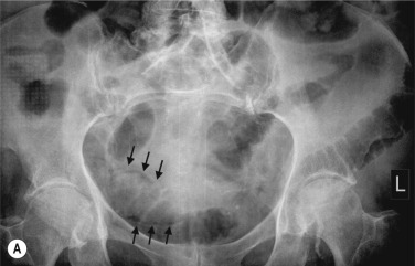 Fig. 18.7, Small-Bowel Ischaemia.