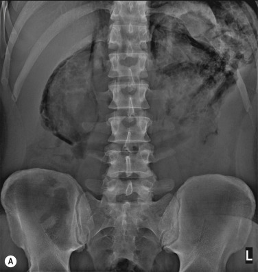 Fig. 18.8, Retroperitoneal Gas.