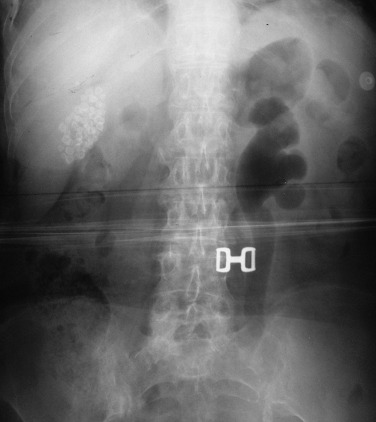 Fig. 18.9, Emphysematous Pyelonephritis.