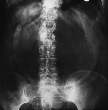 Fig. 18.10, Gastric Volvulus: Supine.