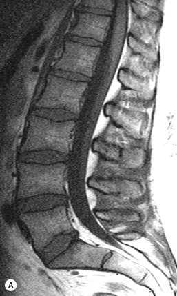 Fig. 47.1, Age-Related Bone Marrow Changes.