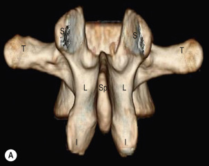 Fig. 47.3, Normal Imaging Anatomy of the Lumbar Spine on Computed Tomography.