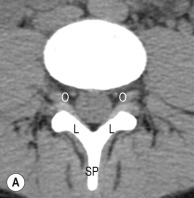 Fig. 47.4, Normal Imaging Anatomy of the Posterior Arch of the Lumbar Spine on Computed Tomography.