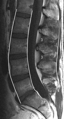 Fig. 47.5, Normal Anatomy of the Spinal Ligaments.