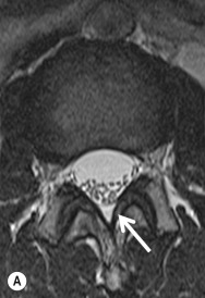 Fig. 47.6, Ligamentum Flavum.