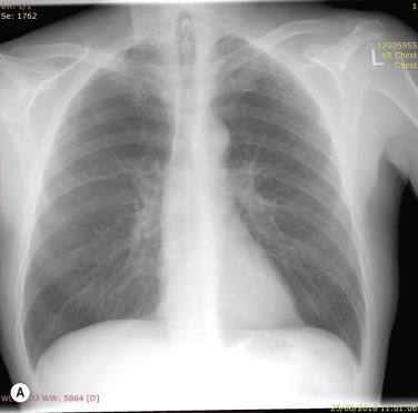 Fig. 1.1, Series of Dual-Energy Subtraction Chest Radiographs in a Man With a Smoking History.