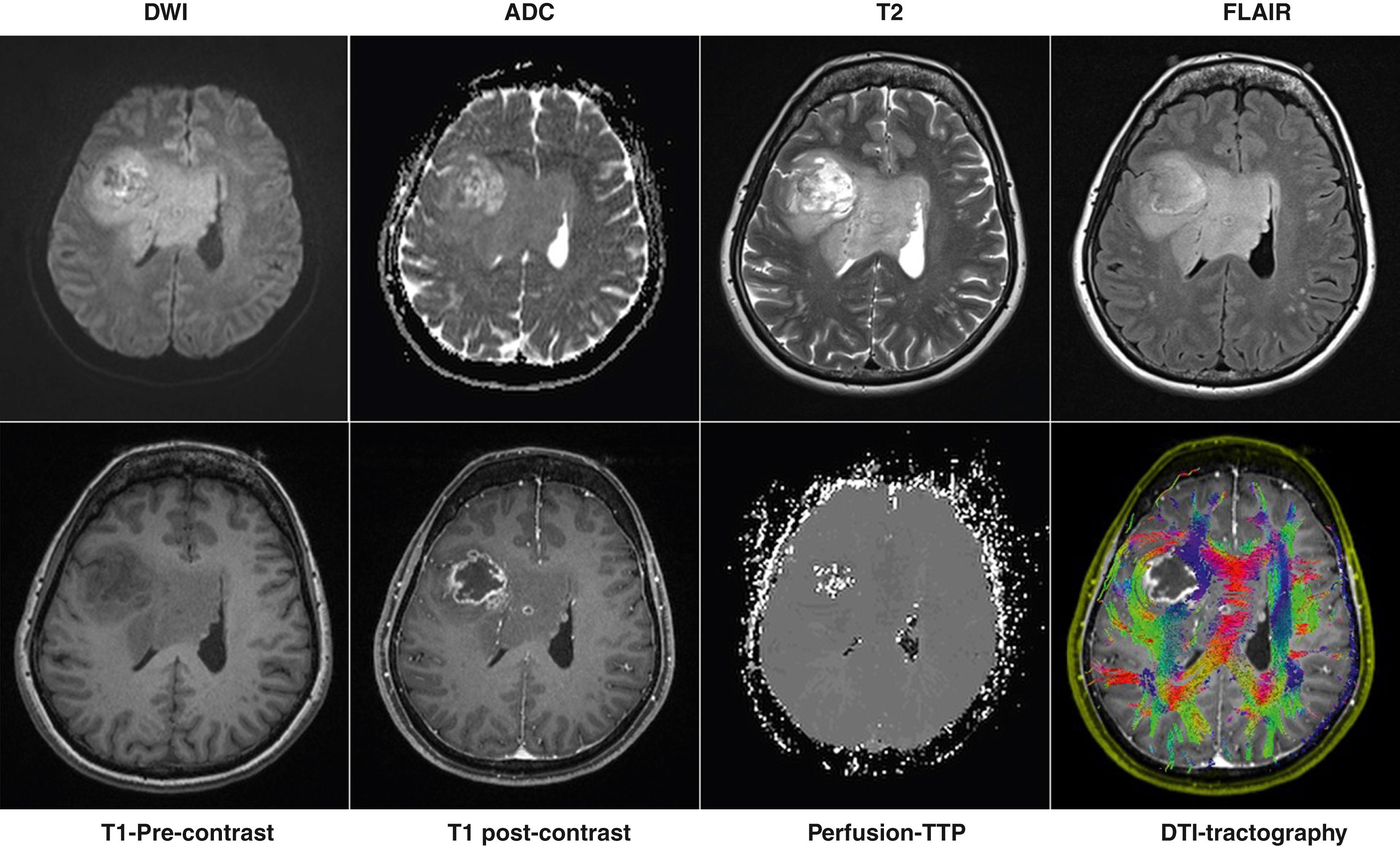 Fig. 7.1, Fifty-one year-old female with 1-year history of left-sided weakness and forgetfulness. Magnetic resonance imaging of the brain demonstrated a right frontal infiltrative ring enhancing mass with an area of central necrosis. Right frontal craniotomy and resection of the tumor revealed glioblastoma isocitrate dehydrogenase wild type. ADC , Apparent diffusion coefficient; DTI , diffusion tensor imaging; DWI , diffusion weight imaging; FLAIR , fluid-attenuated inversion recovery.