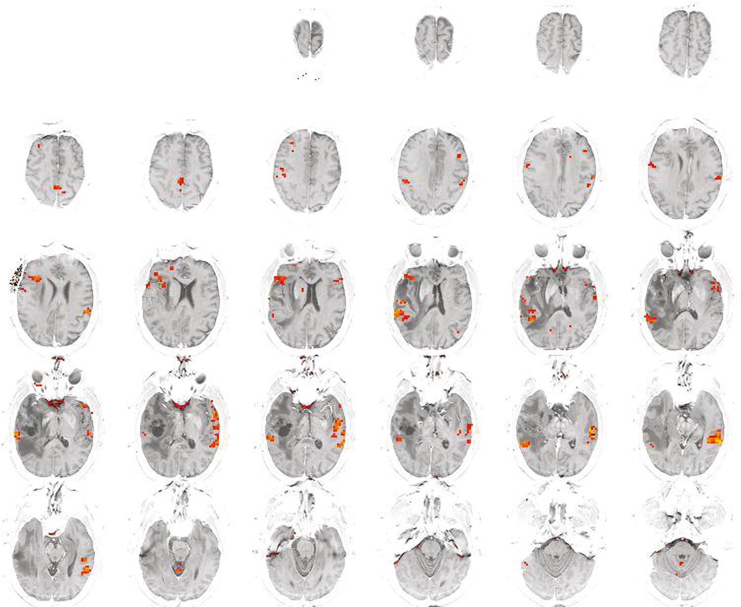 Fig. 7.2, Functional MRI during a silent speech task in a patient with a glioblastoma of the left temporal lobe ( left and right are reversed).