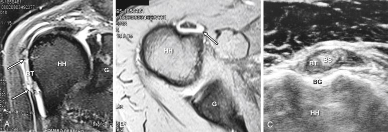 FIG. 46.1, Right Shoulder. (A) MRI coronal slice. G: glenoid. HH: humeral head. BT: biceps tendon. Yellow arrows: degenerative changes at the proximal and distal parts of the tendon. (B) MRI axial slice. G: glenoid. HH: humeral head. BT: biceps tendon surrounded by fluid. (C) Ultrasound scan. HH: humeral head. BG: bicipital groove. BT: biceps tendon. BS: bicipital sheath with increased liquid.