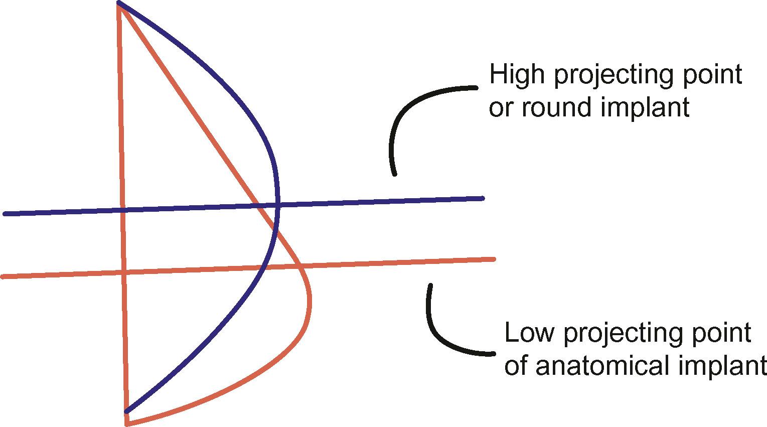 Figure 2.4, The differing projection points between round and anatomical implants.