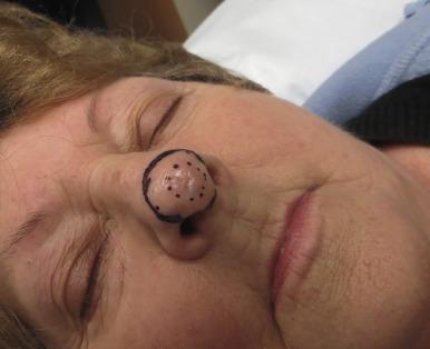 Fig. 47.1, A 65-year-old woman with a 1-cm nodular tip of nose basal cell carcinoma. These lesions are slow growing and often located on the midface. The cosmetic outcome of excision and reconstruction is often suboptimal with radiotherapy (RT), an excellent treatment option. Note the black line delineating the RT field, typically 1 cm beyond gross tumor ( broken line ).