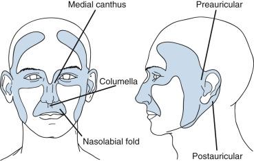 Fig. 47.2, Diagram of H zone. Especially problematic areas are the medial canthus, glabella, nasolabial folds, and periauricular region.