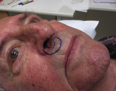 Fig. 47.3, A 73-year-old man with a recurrent basal cell carcinoma located to the right of the superior aspect of his philtrum. He declined surgery based on the need for wide local excision and the difficulty in achieving a cosmetically acceptable (to him) reconstruction. He proceeded to definitive radiotherapy (RT) with the outer blue line delineating his RT field. Because of the risk of deeper invasion, treatment was delivered with orthovoltage energy photons as opposed to superficial energy photons.