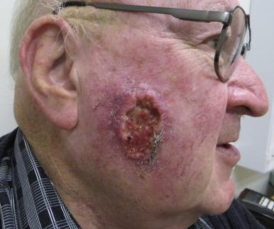 Fig. 47.5, An 83 year-old man with a deeply invasive ulcerative squamous cell carcinoma of the right midcheek. Note the rolled edges and necrotic appearing base. The patient required major surgery and free flap reconstruction followed by adjuvant radiotherapy.