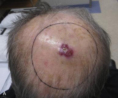 Fig. 47.7, (A) An elderly wheel chair bound man with a rapidly progressing scalp Merkel cell carcinoma. The patient underwent urgent scalp radiotherapy (RT) (40 Gy in 10 fractions using superficial energy photons). Note the wide RT field ( solid black line ) with the aim to treat surrounding dermal lymphatics. (B) Four weeks post completion of RT the patient has complete in-field alopecia and superficial ulceration delineating his primary site. The patient developed distant metastases within 6 months of completing his RT.