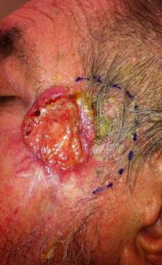 Fig. 34.1, Squamous cell carcinoma on the left temple.
