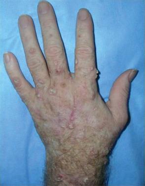 Fig. 34.2, Field cancerization on the hands, also known as transplant hands.