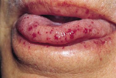 FIGURE 29-3, Hereditary hemorrhagic telangiectasia. Multiple, small telangiectatic mats on the lips and tongue.