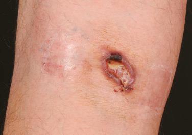 FIGURE 20-1, Cutaneous anaplastic large-cell lymphoma presenting with a solitary ulcerated tumor on the leg.