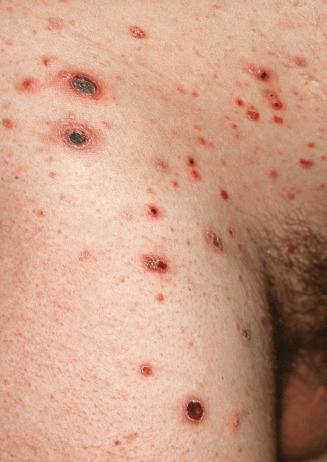 FIGURE 20-2, Lymphomatoid papulosis. Multiple, partly ulcerated papules and plaques.