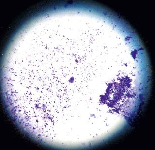 FIGURE 39-2, Tzanck smear demonstrating a multinucleated giant cell centrally.