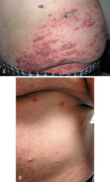 FIGURE 39-3, A, Multiple vesicles on an erythematous base that resemble varicella in a renal transplant patient with disseminated zoster. B, Dermatomal herpes zoster in a renal transplant recipient.