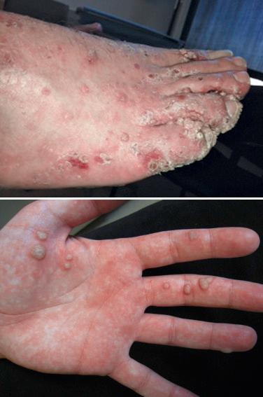 FIGURE 39-4, Multiple verrucae vulgares in a patient who had received a lung transplant.