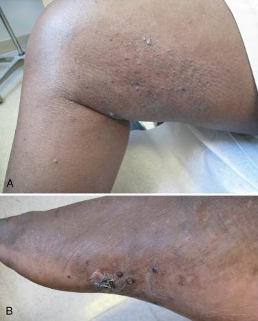 FIGURE 39-5, A, Kaposi sarcoma with woody induration of leg in a renal transplant recipient. B, Kaposi sarcoma of the foot in the same renal transplant recipient.