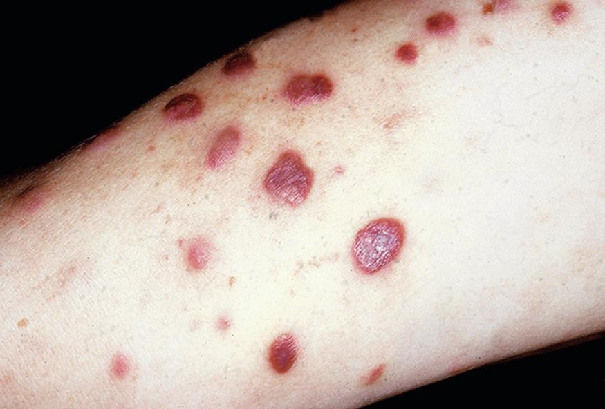Fig. 38.2, Kaposi’s sarcoma. Multiple violaceous papules and plaques.