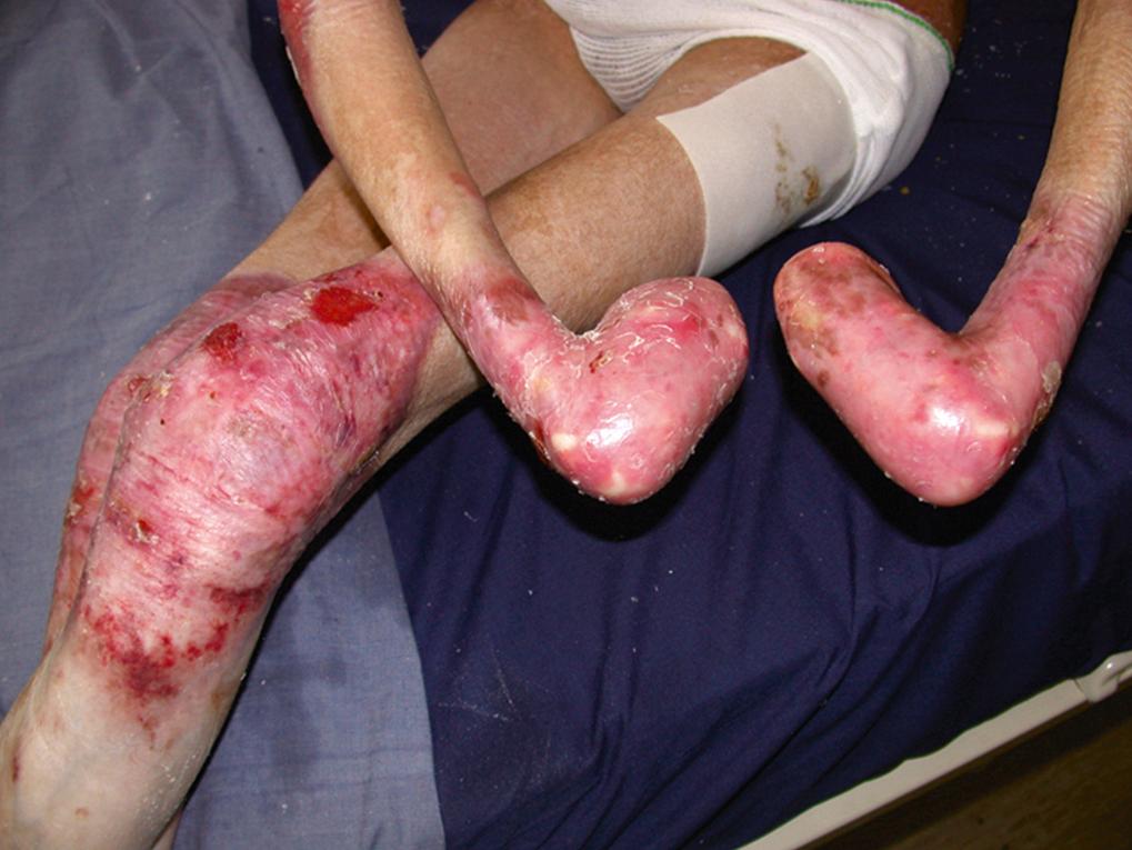 Fig. 25.1, Characteristic lesions resulting from skin fragility caused by severe recessive dystrophic epidermolysis bullosa.