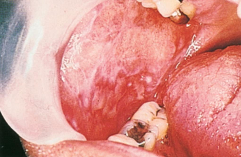 Fig. 25.2, The erosive form of oral lichen planus involving the buccal mucosa. Note the lace-like keratoses, erythema, and ulceration.