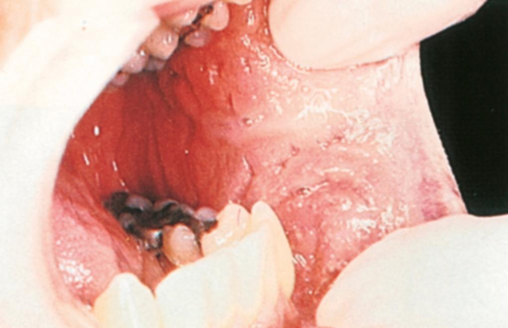 Fig. 25.3, Pyostomatitis vegetans in a patient with UC. A biopsy specimen revealed microabscesses.