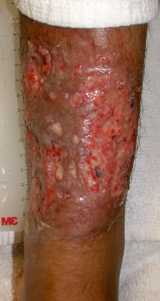 Fig. 25.4, Pyoderma gangrenosum in a patient with UC.