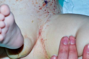 FIGURE 22-2, Acute form of LCH (Letterer–Siwe disease). Petechial and minimally scaly eruption involving the bathing trunk distribution in this child.