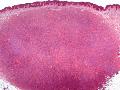 Figure 15.1, Benign Fibrous Histiocytoma.