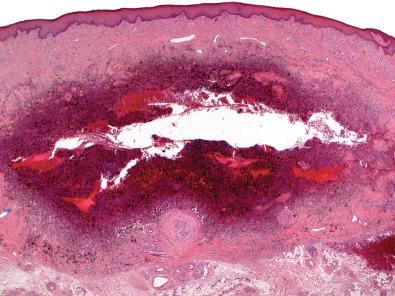 Figure 15.15, Aneurysmal Benign Fibrous Histiocytoma.