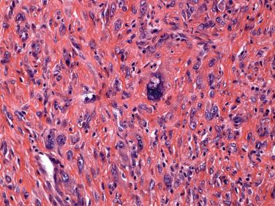 Figure 15.16, Atypical Fibrous Histiocytoma.